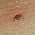 Nymphe eines Gemeinen Holzbocks (Ixodes ricinus), diese Exemplar in der Kniekehle war etwa so groß wie ein Mohnkorn und sah für das bloße Auge schwarz aus

Überträger der für den Menschen gefährlichen Lyme-Borreliose und der Frühsommer-Meningoenzephalitis (FSME)